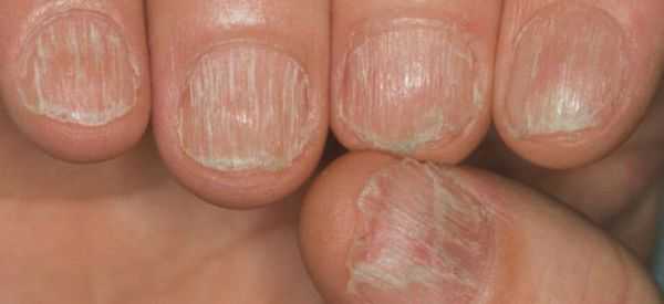 Трахионихия