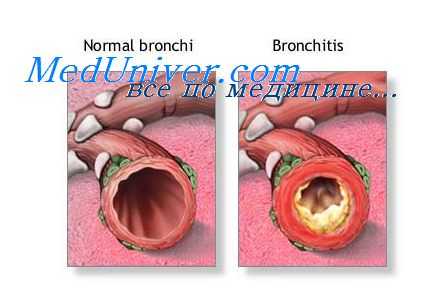 вирусное воспаление