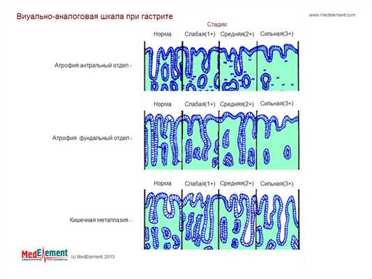 Визуально-аналоговая шкала при гастрите
