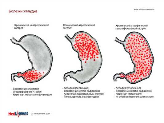 Хронические гастриты