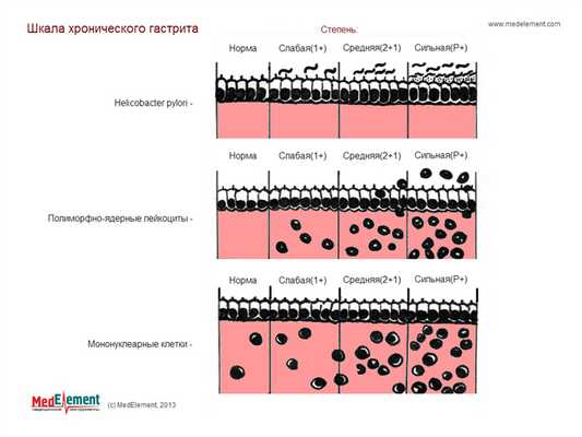 Шкала хронического гастрита