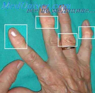 глубокая пальпация сустава