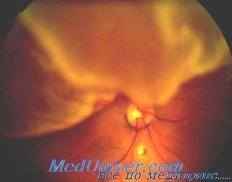 фиброваскулярная пролиферация стекловидного тела