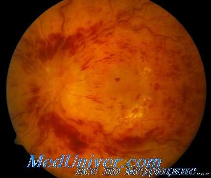 окклюзия вен сетчатки