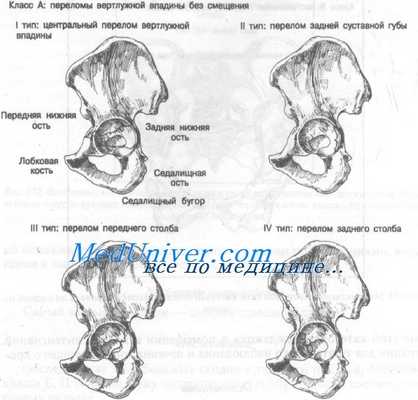 перелом вертлужной впадины