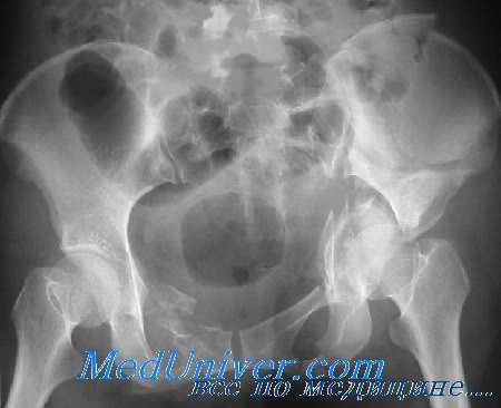 перелом вертлужной впадины