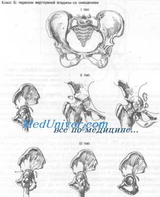 перелом вертлужной впадины