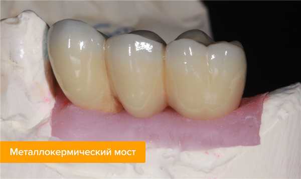Фото металлокерамического моста