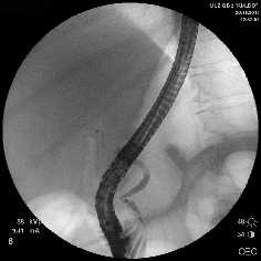 Рис. 1. Рентген-фото выявленной патологии