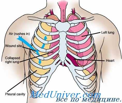 травма сосудов грудной полости