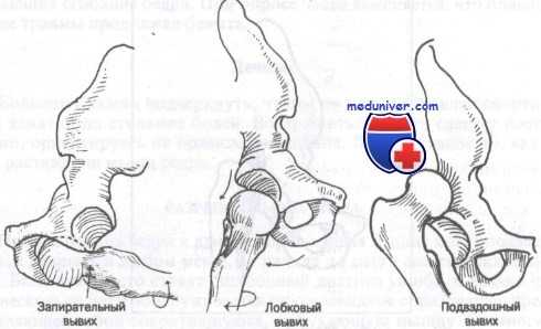 вывих бедра