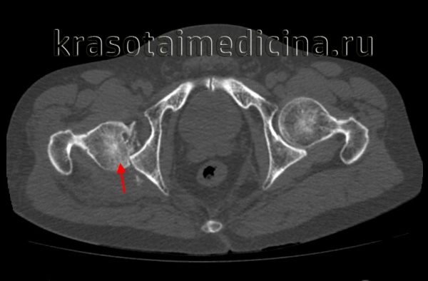вывих бедра