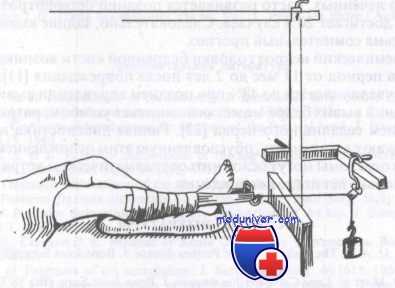 вывих бедра