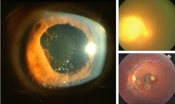 Глазной токсоплазмоз