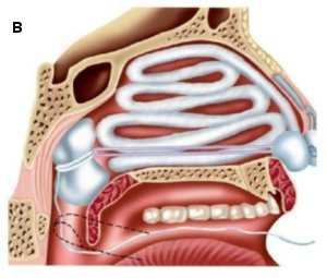Тампонада носа