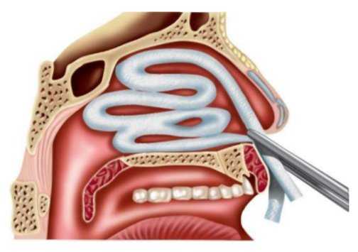 Тампонада носа