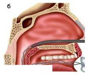 Тампонада носа