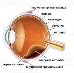 Витреоретинальная патология - отслоение сетчатки