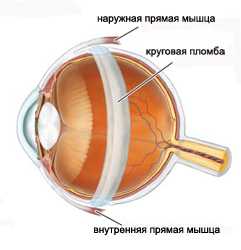 Витреоретинальная хирургия при отслойке сетчатки