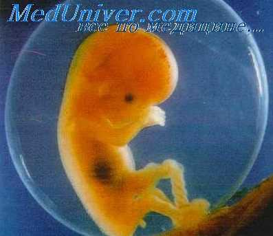 танатоформная дисплазия