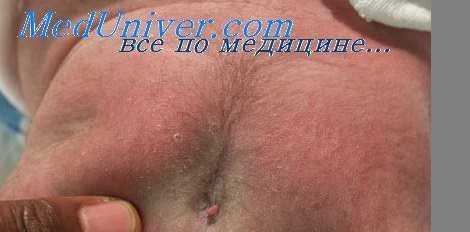 танатофорная дисплазия