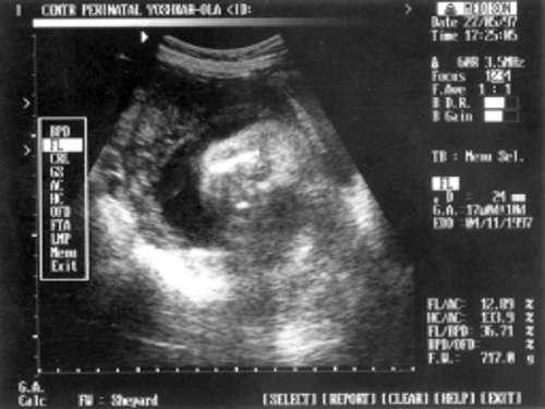 УЗИ плода - бедро
