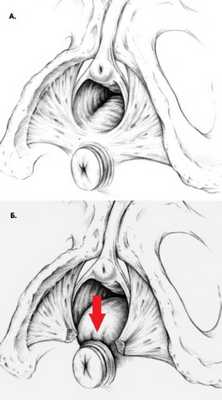Разрыв промежности и ректоцеле
