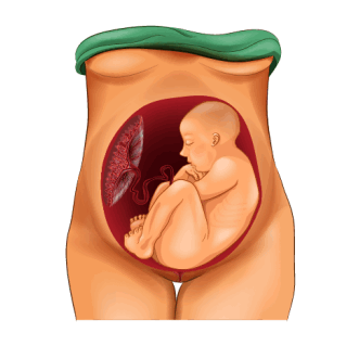 Тазовое предлежание плода