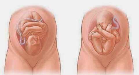 Тазовое предлежание плода