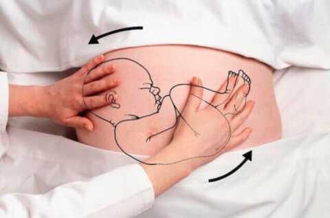 Тазовое предлежание плода