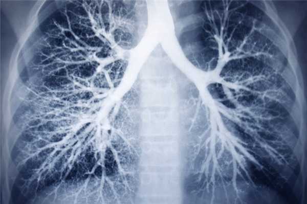 Бронхоэктатическая болезнь у детей