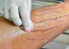 Болезнь кошачьих царапин (фелиноз)