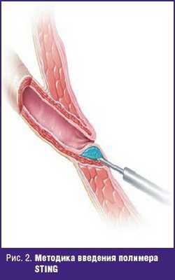 Методика введения полимера STING