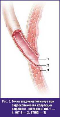 Точки введения полимера при эндоскопической коррекции рефлюкса.
