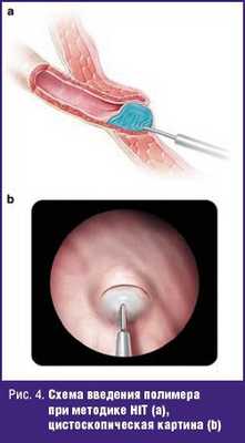 Схема введения полимера