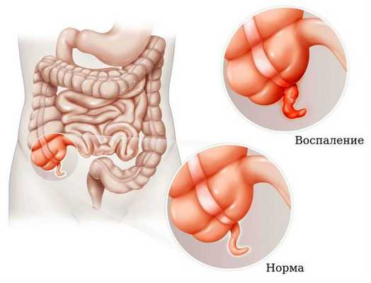 Аппендицит