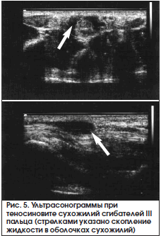 Рис. 5. Ультрасонограммы при теносиновите сухожилий сгибателей III пальца (стрелками указано скопление жидкости в оболочках сухожилий)