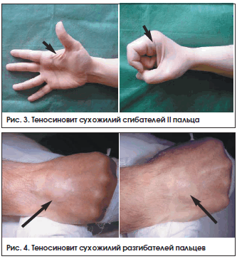 Рис. 3. Теносиновит сухожилий сгибателей II пальца