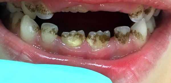 Зубной налёт у ребёнка 