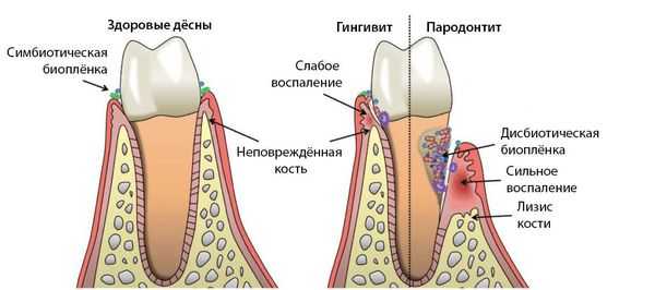 Пародонтит и гингивит