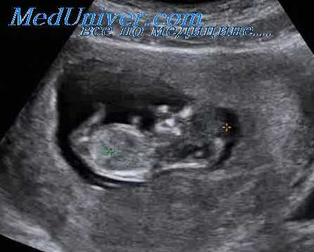 многоплодная беременность