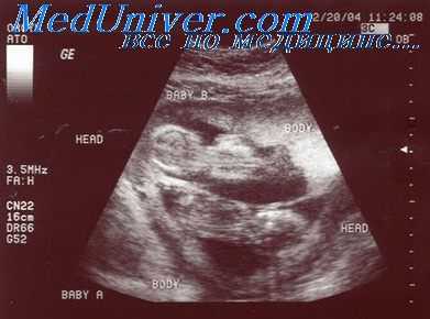 аномалии многоплодной беременности