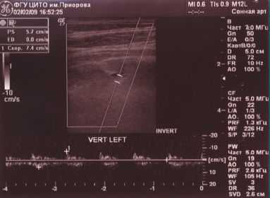 Рис. 2. Гипоплазия левой ПА