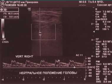 Рис. 3. Ультразвуковая диагностика диаметра и скорости кровотока по правой ПА в нейтральном положении головы