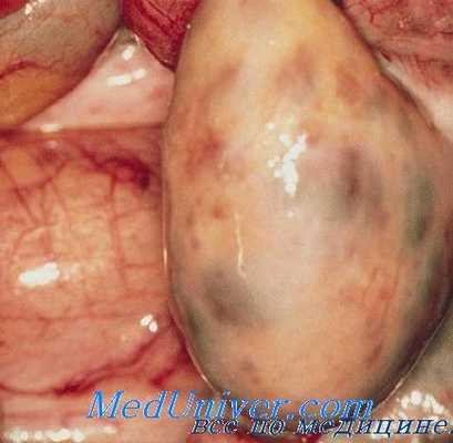 синдром штейна-левенталя