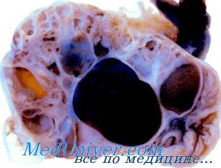 нарушения яичников