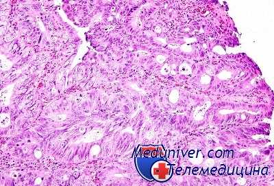 опухоли кишечника