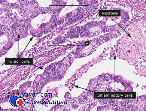 множественные опухоли пищеварительной системы