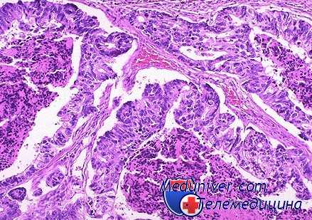 мультицентрический канцерогенез