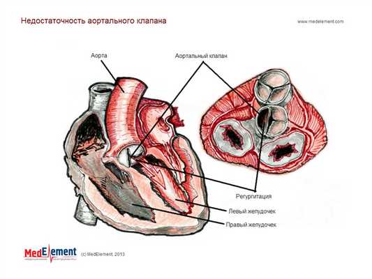 Недостаточность аортального клапана